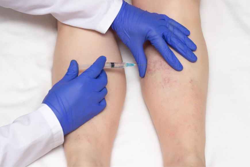 The Varicose Veins Treatment in Dubai That Is Quick and Effective The Varicose Veins Treatment in Dubai That Is Quick and Effective
